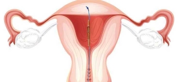 GYNEFİX (yeni nesil spiral) - GYNEFİX ANKARA